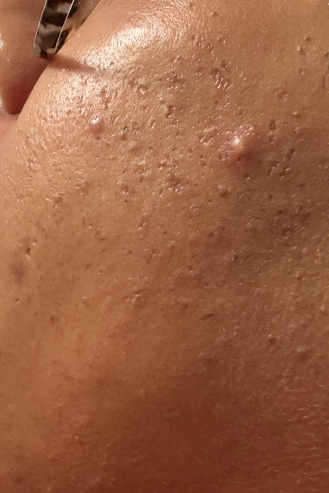 La Roche-Posay Effaclar Adapalene Gel 0.1% Acne Treatment, Retinoid Cream, Acne Medication Gel for Blackheads & Whiteheads, Oil Free customer photo 1