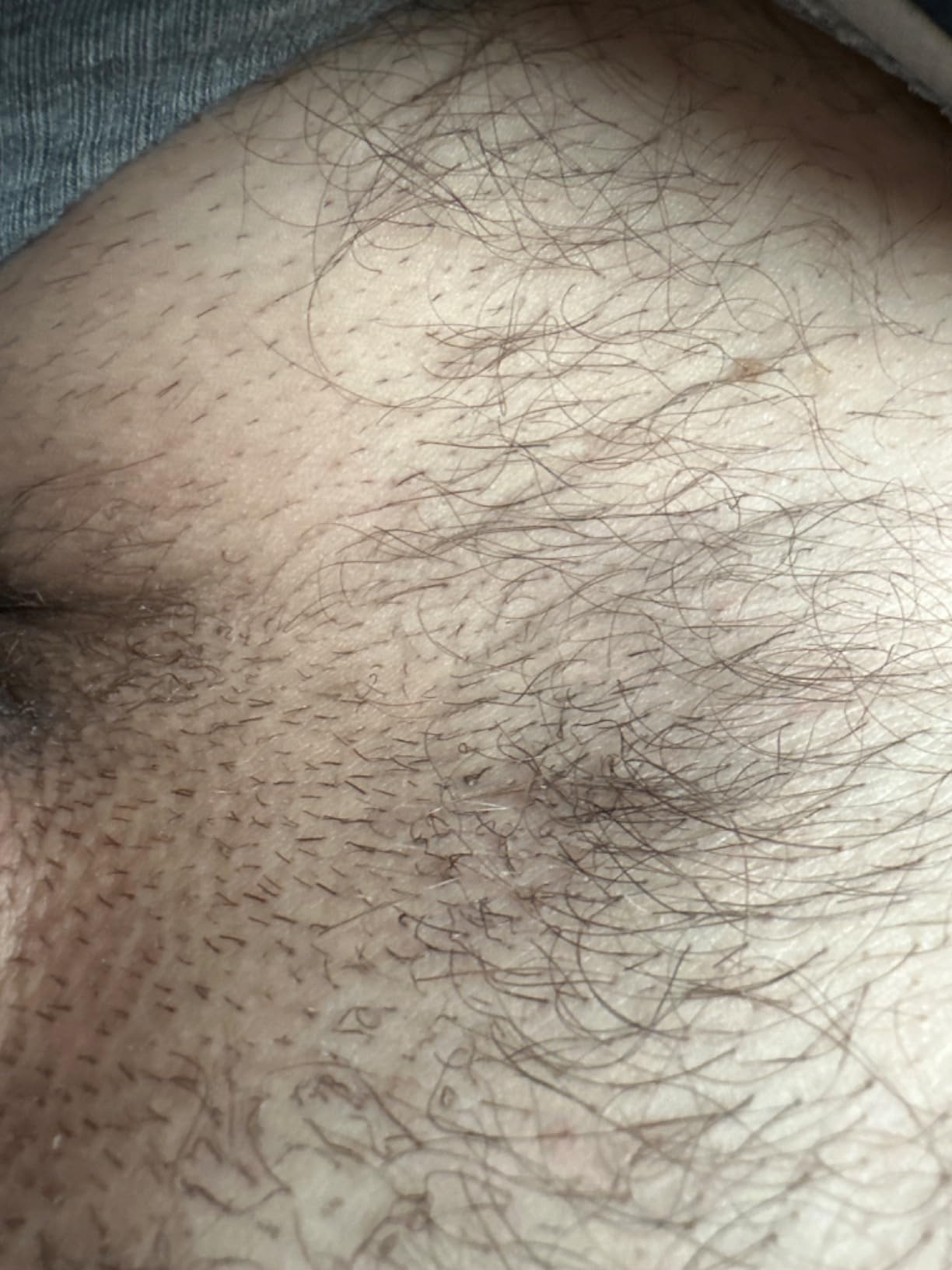 Braun Smart IPL, Skin i-Expert Pro 7, VOGUE's Best Hair Removal Device, IPL Hair Removal for Women and Men, Permanent Laser Hair Reduction At-Home, World's 1st Smart App, 3 Heads, IPL7243 customer photo 1