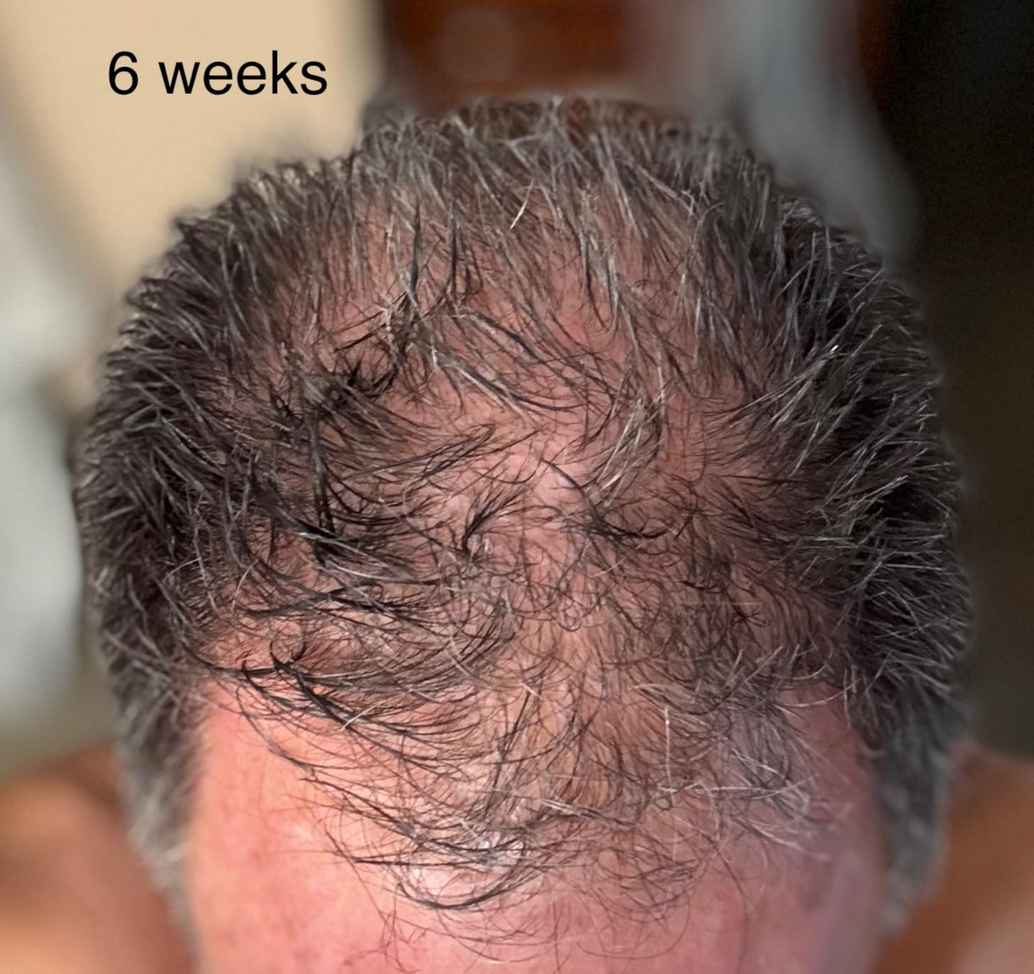iRestore Professional Laser Red Light Therapy for Hair Growth System - FDA Cleared Hair Loss, Hair Thinning & Alopecia Treatment for Men & Women - 282 Lasers & LEDs customer photo 2