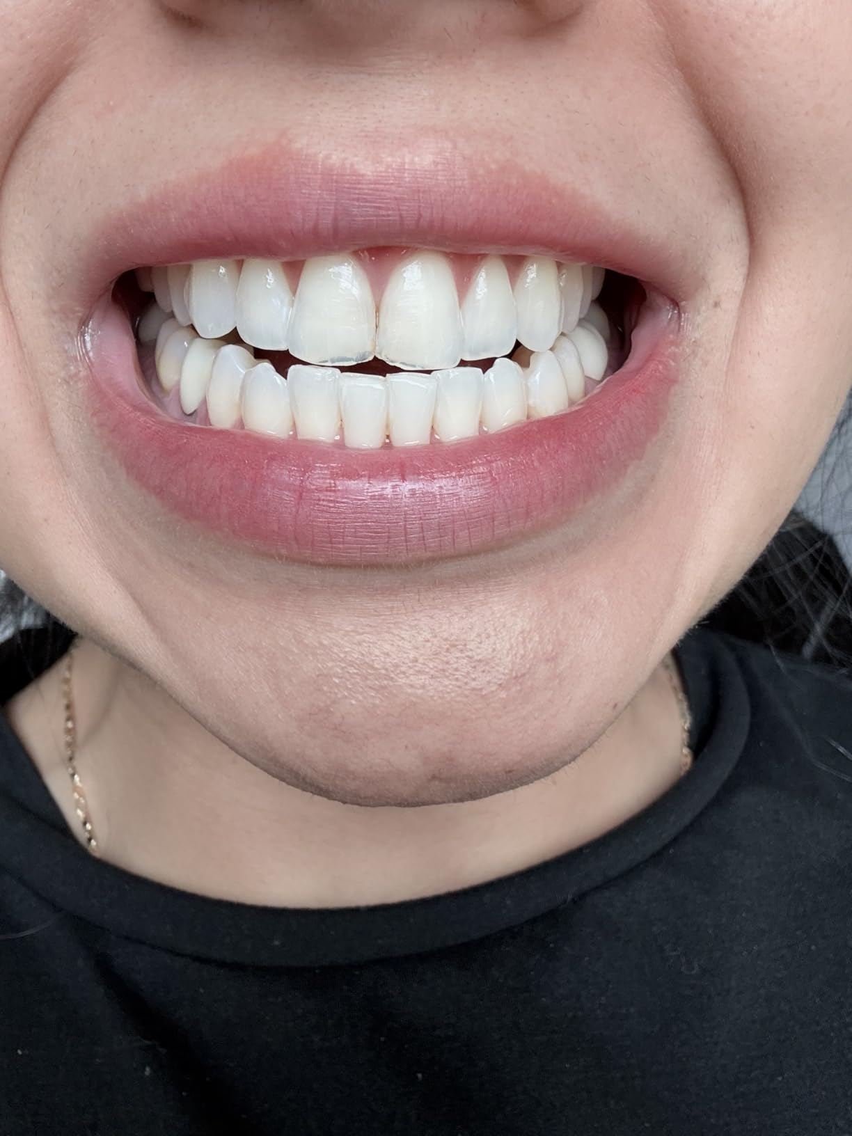 Crest 3DWhitestrips Sensitive White At-Home Teeth Whitening Kit, 18 Treatments, Gently Removes 15 Years of Stains customer photo 1