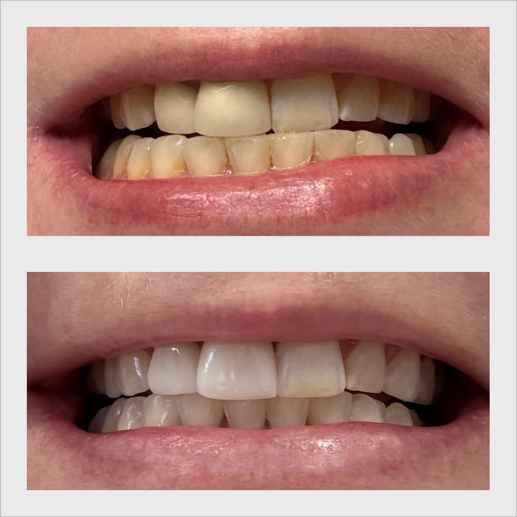 Opalescence GO 15 Teeth Whitening Trays & Sensitive Toothpaste | Hydrogen Peroxide Gel Prefilled Trays and Opalescence Whitening Toothpaste 4.7 Oz - Mint Flavor (10 Treatments) customer photo 1