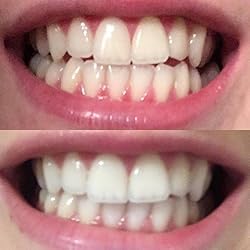Teeth Whitening Kit with LED Light Tray for Sensitive Teeth, 5 Tooth Whitening Pen Gel Pain Free and Enamel Safe, Teeth Whitener at Home Up to 1-9 Shades Whiter in 1-2 Weeks customer photo 2